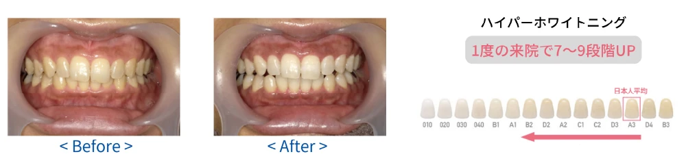 ホワイトニング材の違い1PC