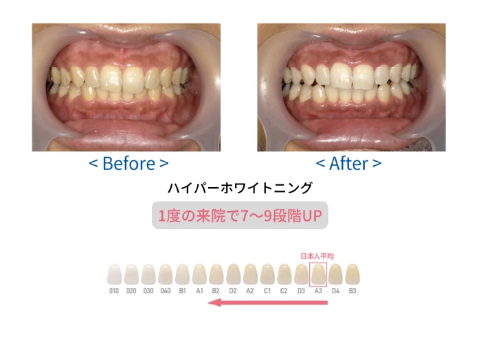 ホワイトニング材の違い1SP